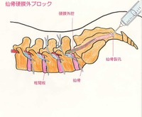 仙骨硬膜外ブロック注射
