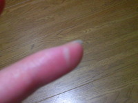 火傷した…
